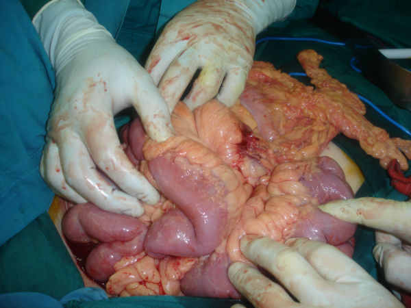 Crohn Diseases ( surgical treatment )